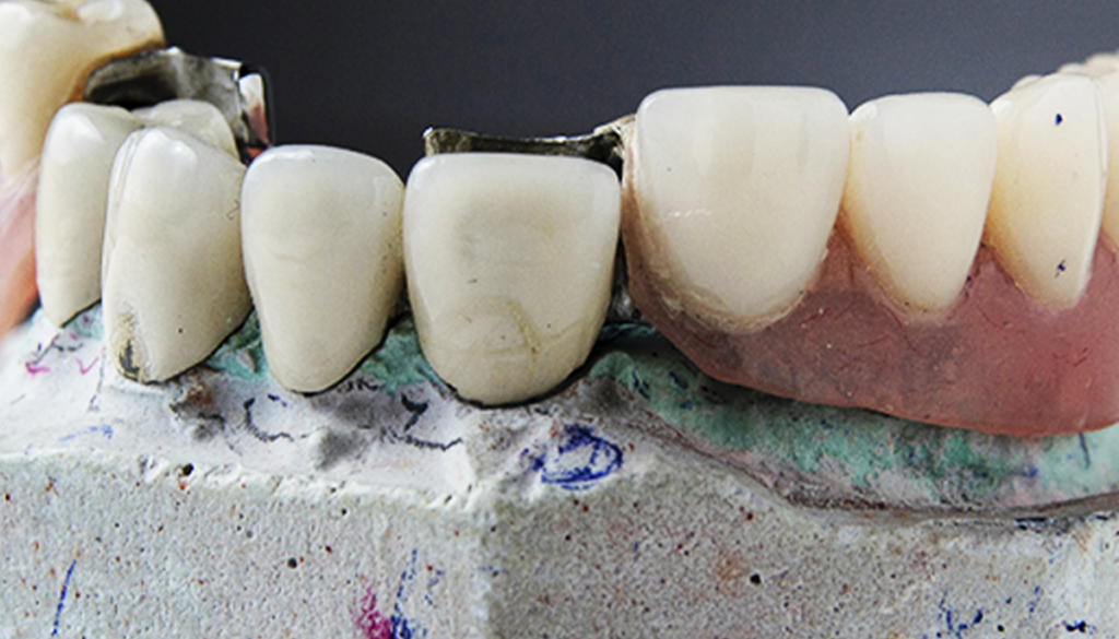 Fixed Prostheses Dental Prosthetics - Olá Sorrisos